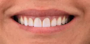 Antes - Dentes Amarelados